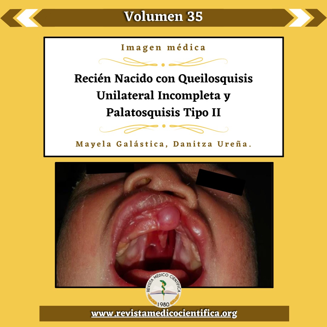 Newborn with Incomplete Unilateral Cheiloschisis and Type II Palatoschisis